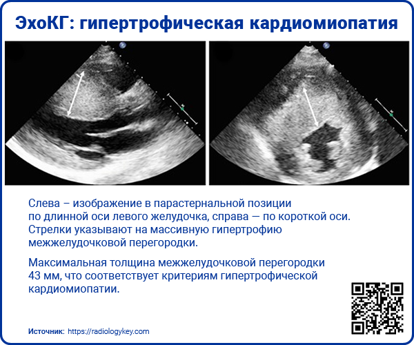 ЭхоКГ гипертрофическая кардиомиопатия